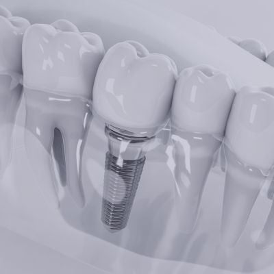 dental implants in Scarborough