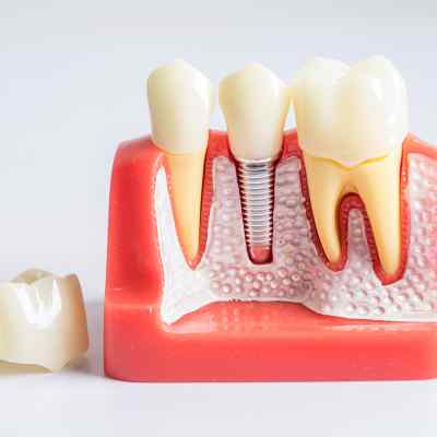 Root Canal Treatment